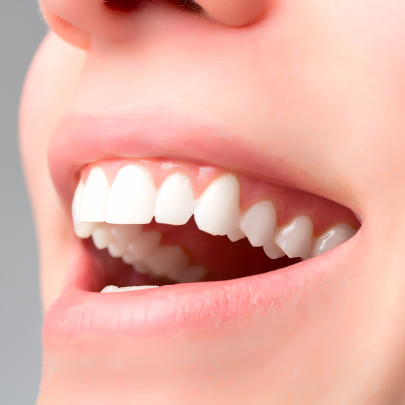 Teaser-schoene-zaehne-ok